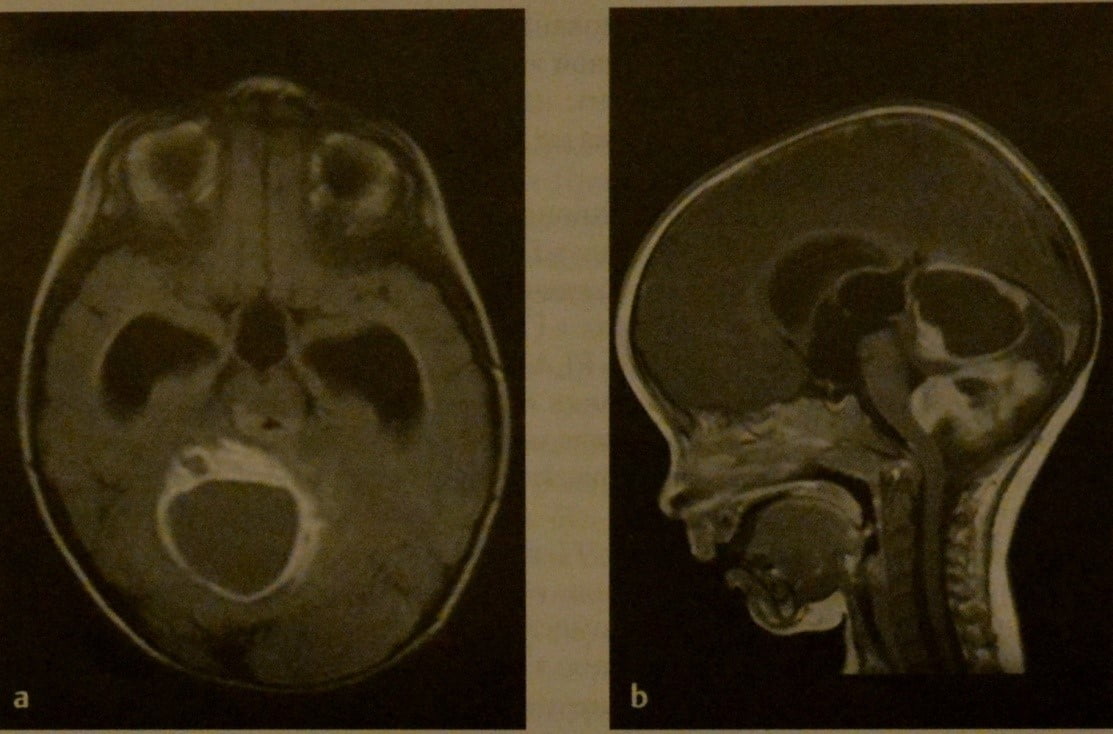 Снимки МРТ и КТ. Опухоли задней черепной ямки у детей