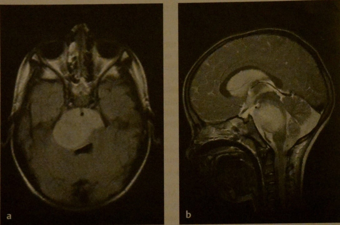 Снимки МРТ и КТ. Глиомы ствола мозга