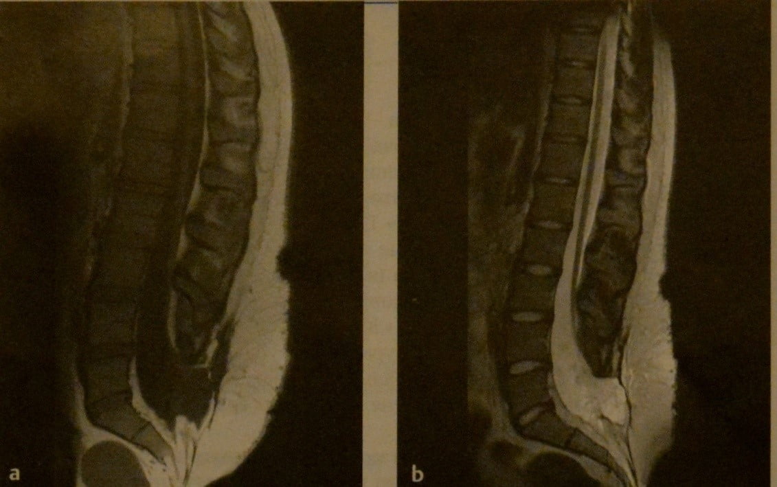 Снимки МРТ и КТ. Фиксированный спинной мозг (тетеринг-синдром)