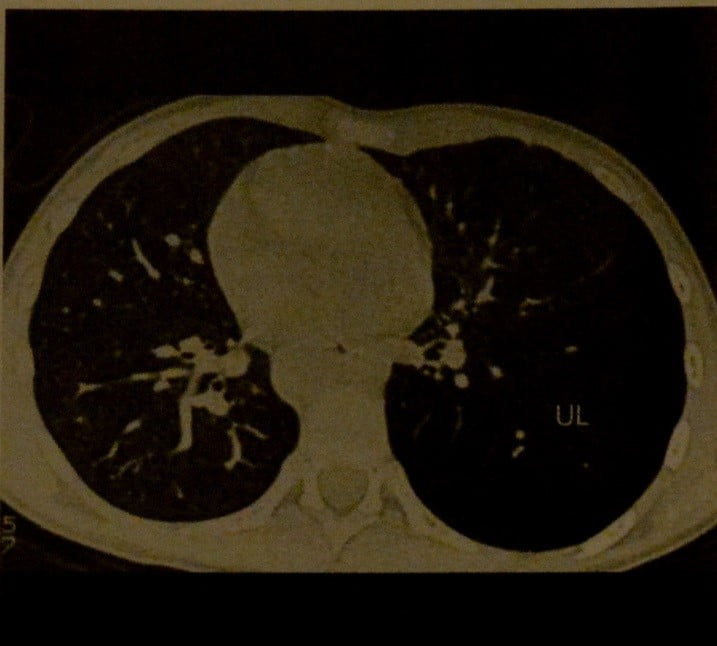 Снимки МРТ и КТ. Врожденная лобулярная эмфизема