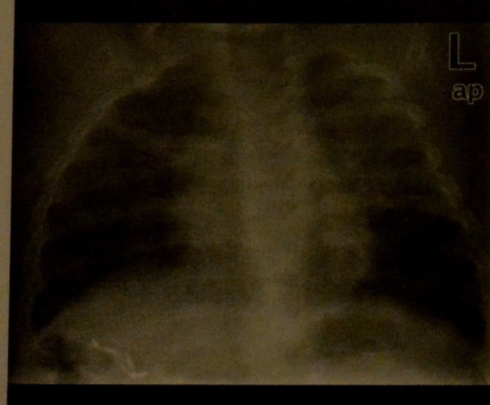 Снимки МРТ и КТ. Бронхиолит, вызванный респираторным синцитиальным 