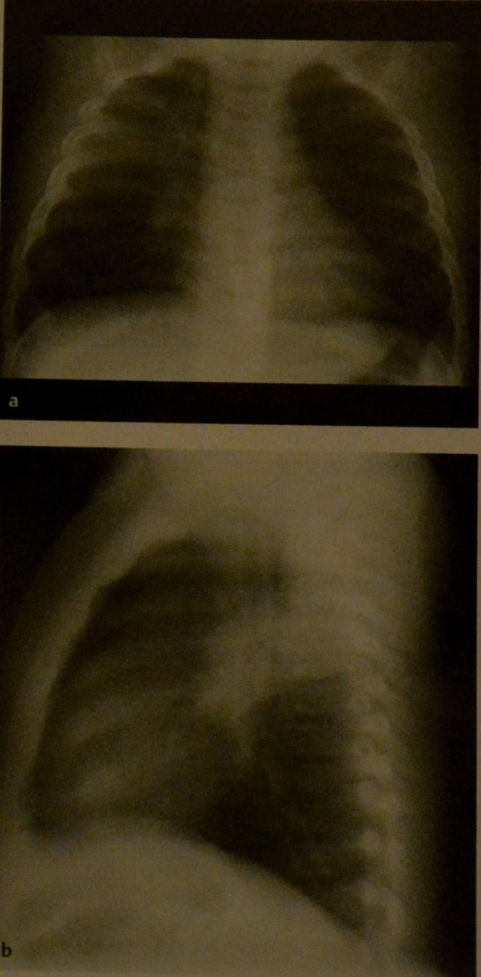 Снимки МРТ и КТ. Долевая и сегментарная пневмония