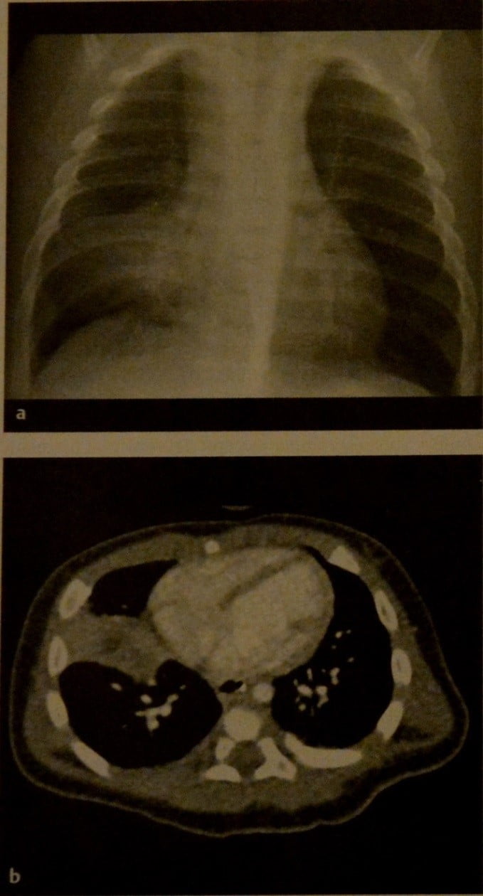 Снимки МРТ и КТ. Туберкулез