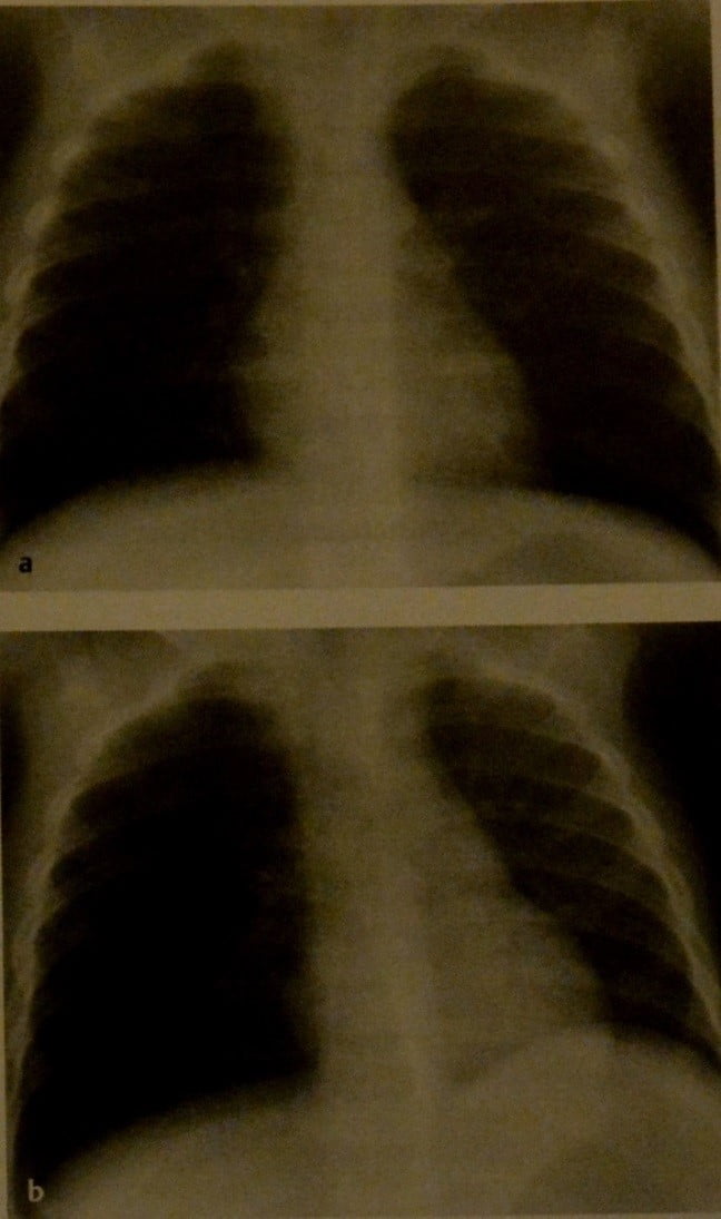 Снимки МРТ и КТ. Аспирация инородного тела