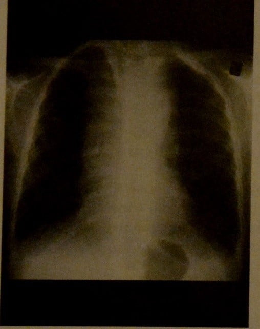 Снимки МРТ и КТ. Лимфома Ходжкина грудной клетки