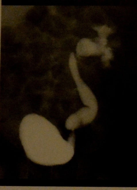Снимки МРТ и КТ. Пузырно-мочеточниковый рефлюкс