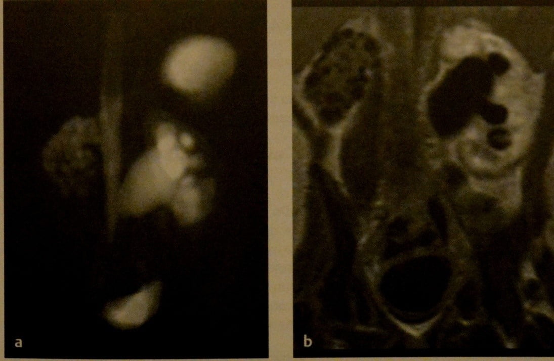 Снимки МРТ и КТ. Мультикистозная дисплазия почки