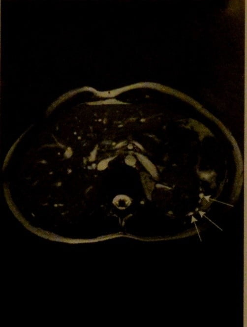 Снимки МРТ и КТ. Опухоль Вильмса (нефробластома почки)