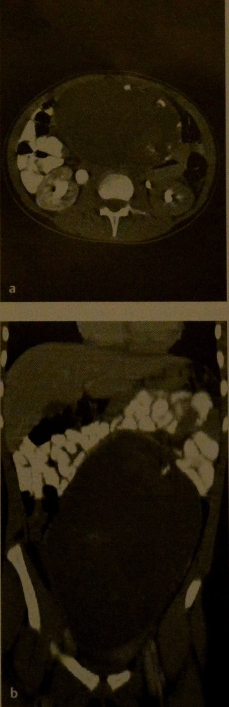 Снимки МРТ и КТ. Тератома яичника у ребенка