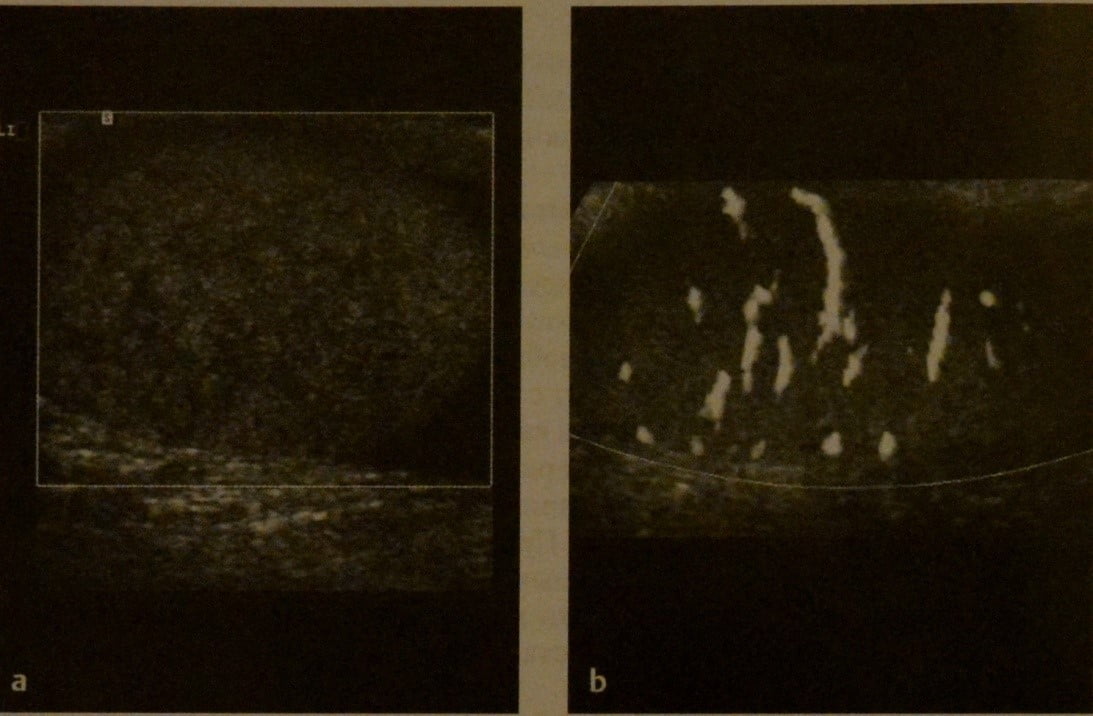 Снимки МРТ и КТ. Перекрут яичка