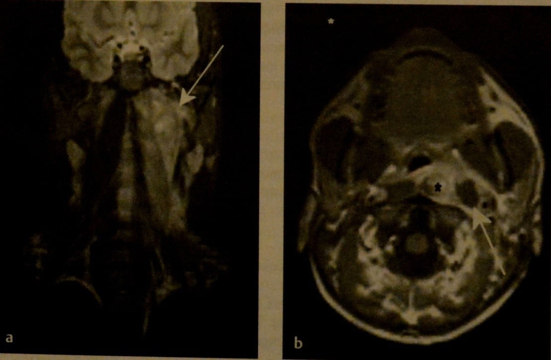 Снимки МРТ и КТ. Заглоточный абсцесс у ребенка