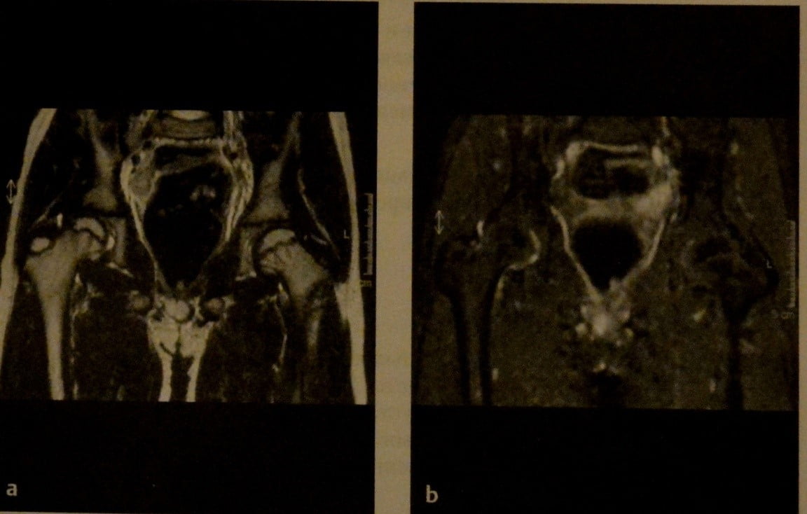 Снимки МРТ и КТ. Транзиторный синовит тазобедренных суставов