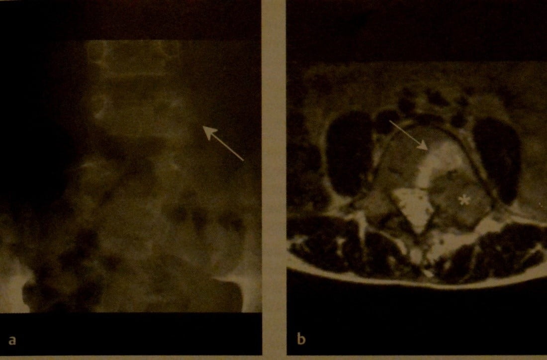 Снимки МРТ и КТ. Аневризматическая костная киста