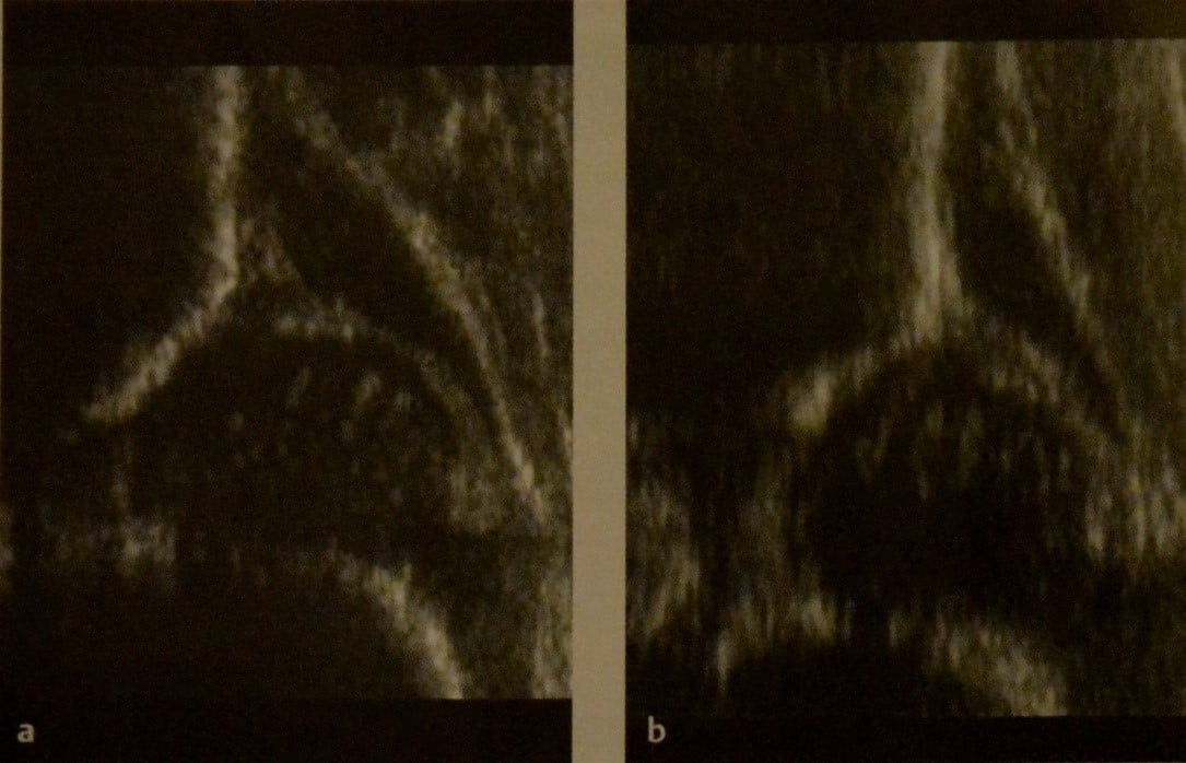 Снимки МРТ и КТ. Дисплазия тазобедренного сустава у детей