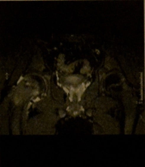 Снимки МРТ и КТ. Подвывих головки бедренной кости