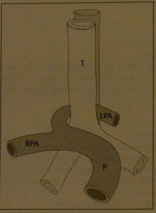 Снимки МРТ и КТ. Аберрантная легочная артерия