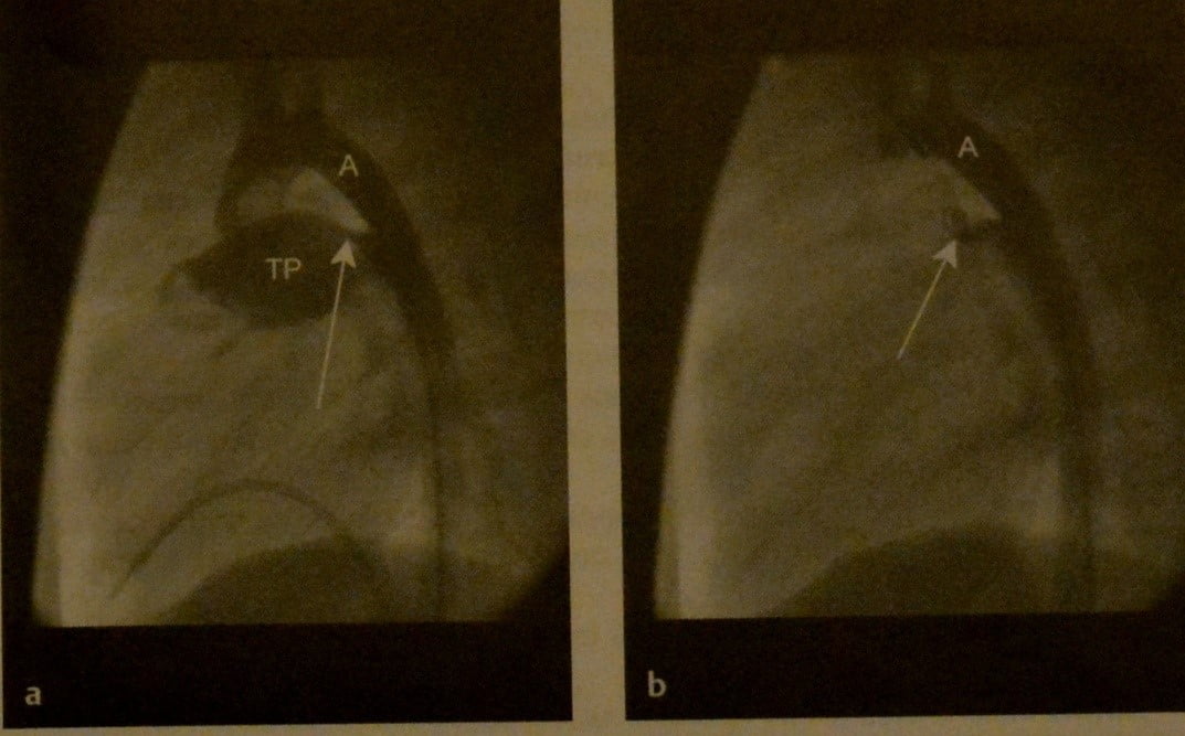 Снимки МРТ и КТ. Открытый артериальный проток у детей