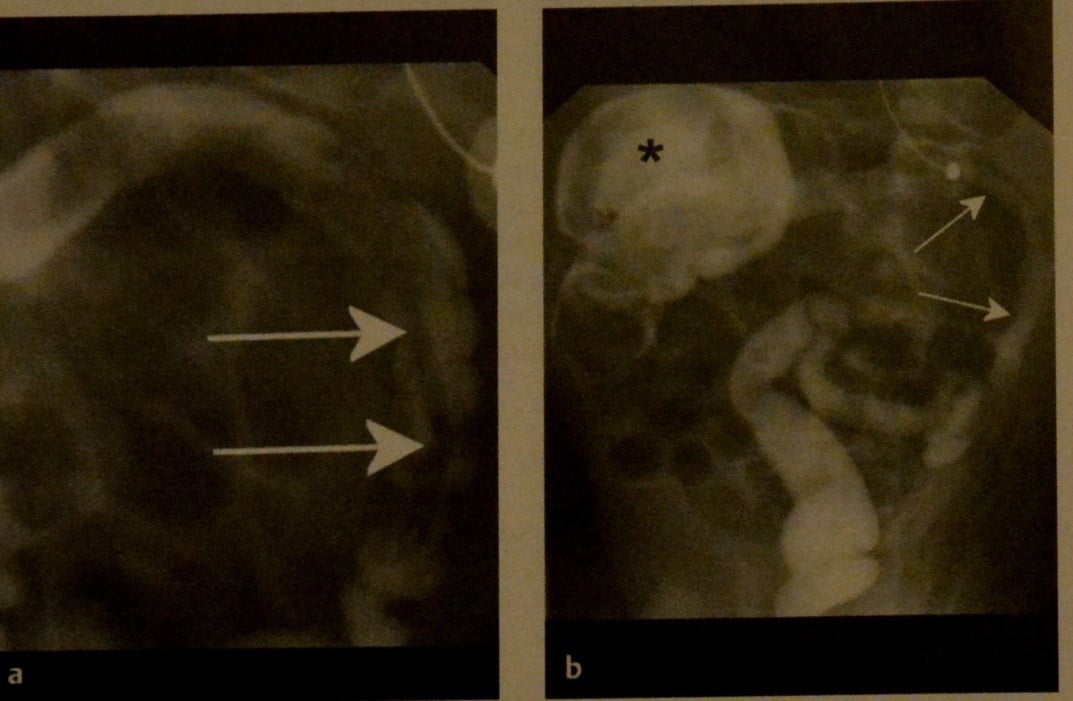 Снимки МРТ и КТ. Мекониевая кишечная непроходимость