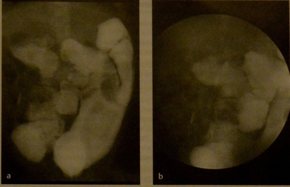 Снимки МРТ и КТ. Мальротация с заворотом кишки