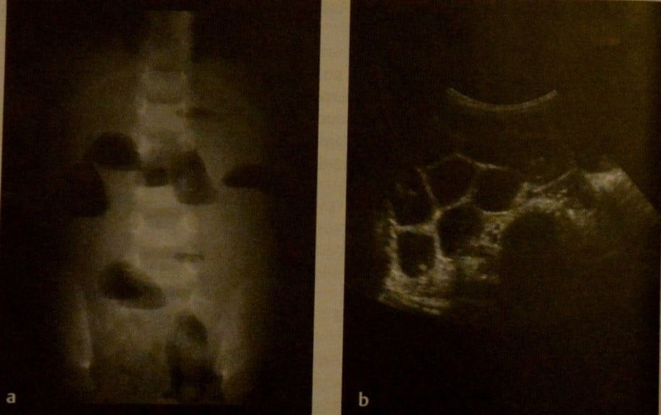 Снимки МРТ и КТ. Заворот тонкого и толстого кишечника