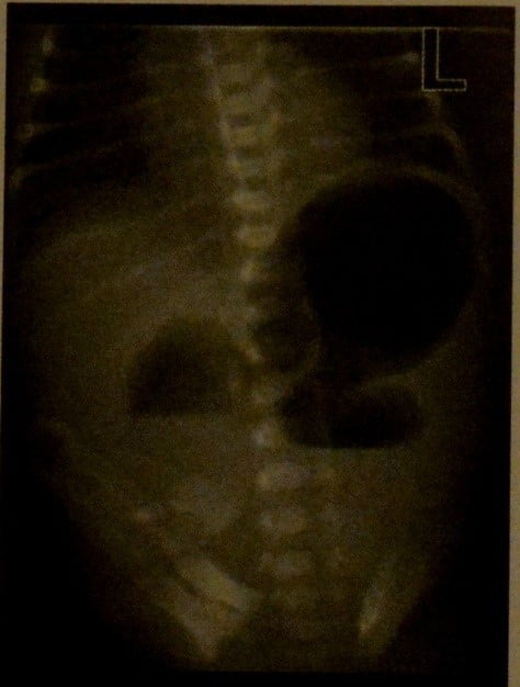 Снимки МРТ и КТ. Атрезия тонкого кишечника