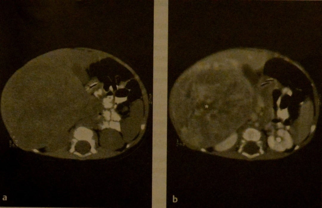 Снимки МРТ и КТ. Гепатобластома