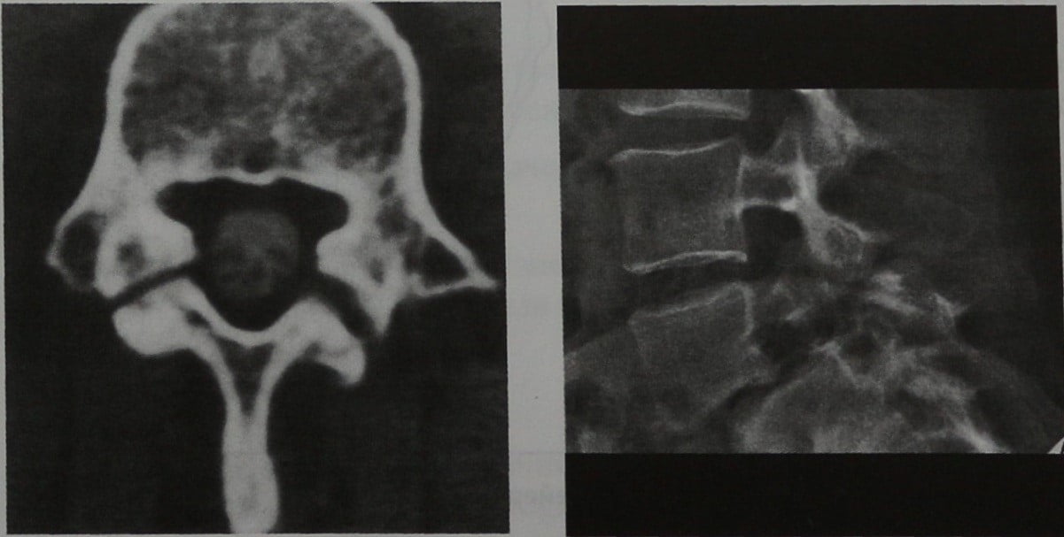 Снимки МРТ и КТ. Повреждение позвоночника вследствие перегрузки