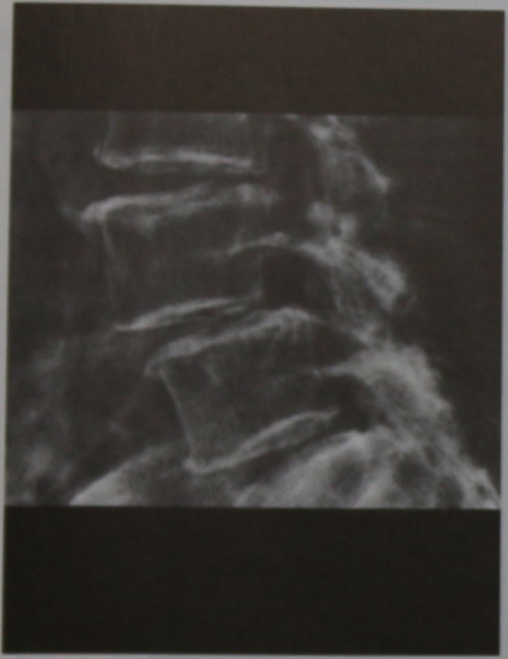 Снимки МРТ и КТ. Повреждение позвоночника вследствие перегрузки