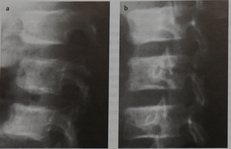 Снимки МРТ и КТ. Перелом Чанса (перелом ремня безопасности)