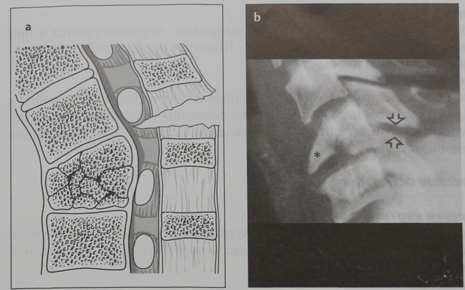Снимки МРТ и КТ. Сгибательный перелом шейного отдела позвоночника