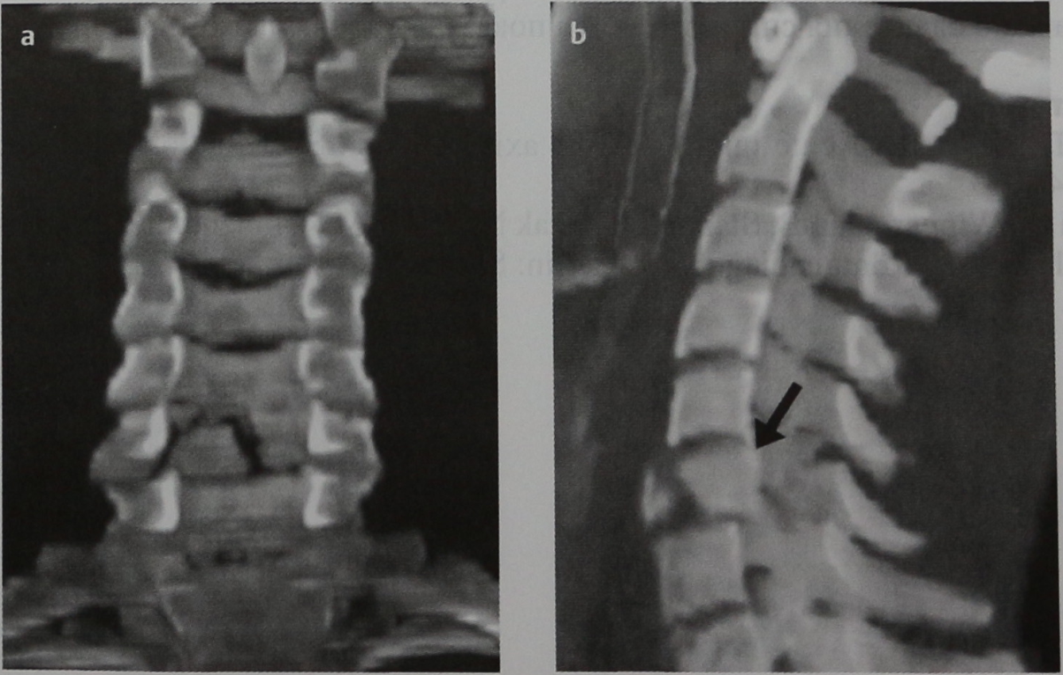 Снимки МРТ и КТ. Сгибательный перелом шейного отдела позвоночника