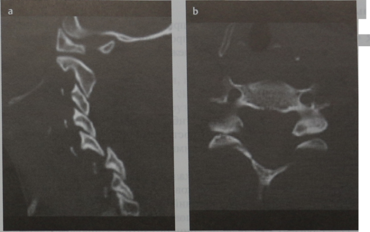 Снимки МРТ и КТ. Передний подвывих