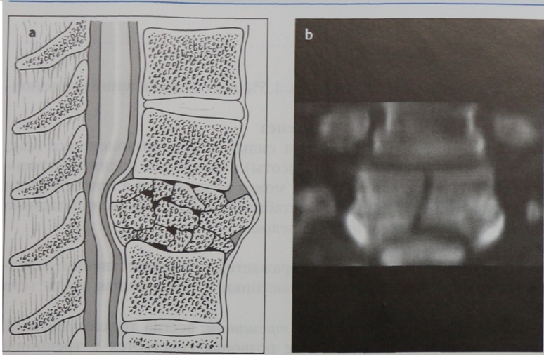 Снимки МРТ и КТ. Оскольчатый перелом позвоночника
