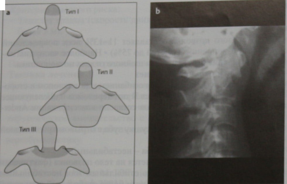 Снимки МРТ и КТ. Перелом зуба осевого позвонка