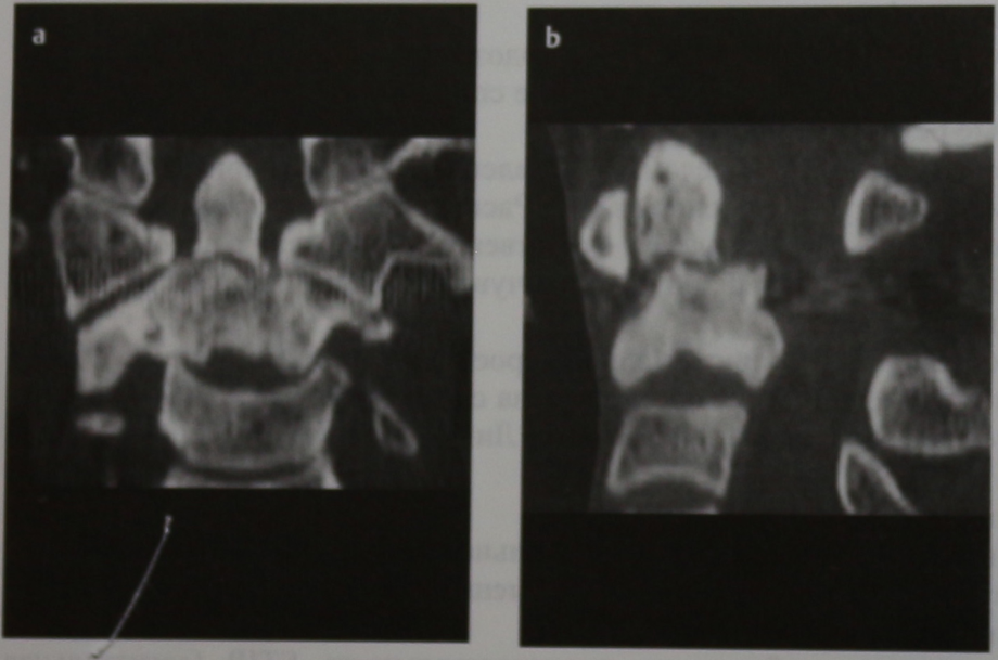 Снимки МРТ и КТ. Перелом зуба осевого позвонка