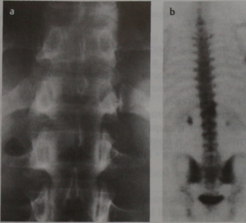 Снимки МРТ и КТ. Остеоид-остеома