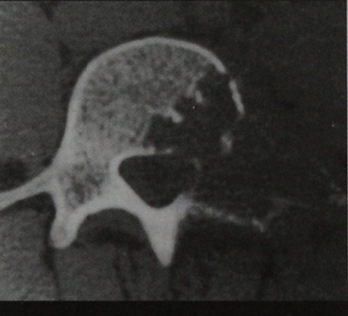 Снимки МРТ и КТ. Остеобластома