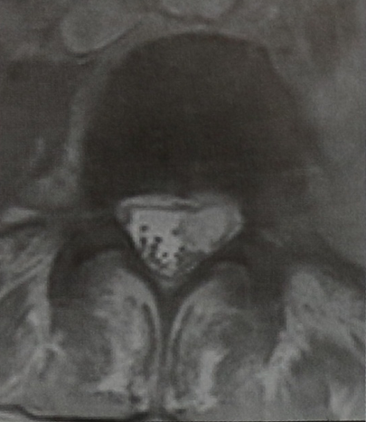 Снимки МРТ и КТ. Опухоли оболочек нервов