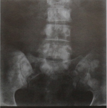 Снимки МРТ и КТ. Метастазы в кости