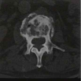 Снимки МРТ и КТ. Метастазы в кости