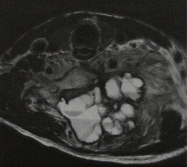 Снимки МРТ и КТ. Аневратическая костная киста