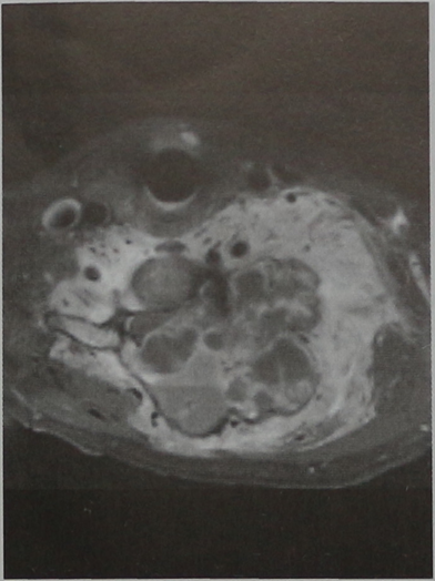 Снимки МРТ и КТ. Аневратическая костная киста