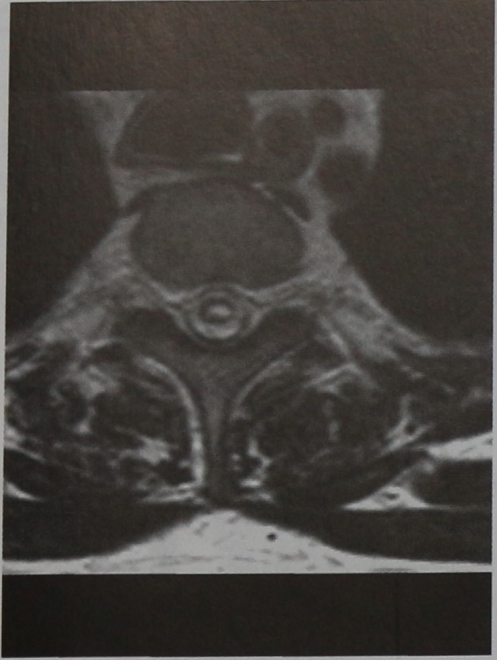 Снимки МРТ и КТ. Сирингомиелия