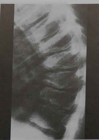 Снимки МРТ и КТ. Болезнь Шейермана-Мау