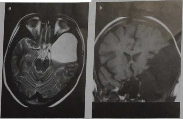 Снимки МРТ и КТ. Киста паутинной оболочки