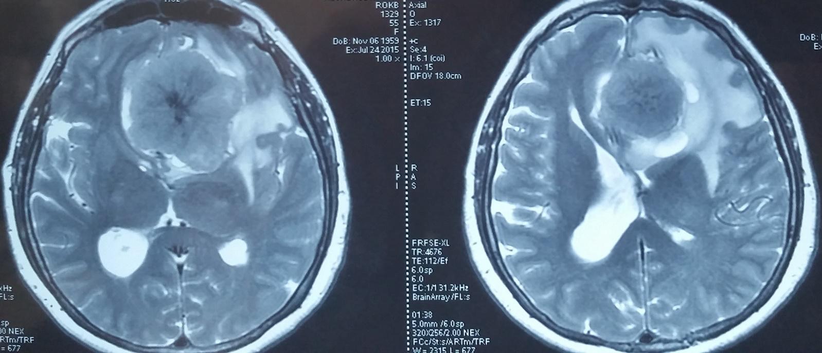 Снимки МРТ и КТ. Менингиома основания черепа