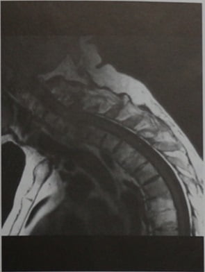 Снимки МРТ и КТ. Переломы позвоночника, анкилозирующий спондилит