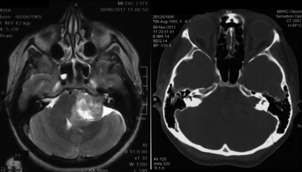 Снимки МРТ и КТ. Опухоли из оболочек нервов