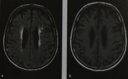 Снимки МРТ и КТ. Церебральная микроангиопатия