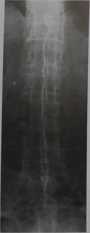 Снимки МРТ и КТ. Оссификация связок при спондилите